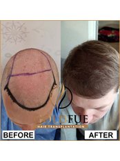 Hair Transplant - Gold Fue Hair Clinic