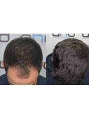 DHI - Direct Hair Implantation - Hair Transplantation - Dr. Hakan Doganay