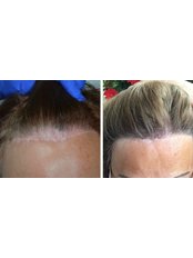 Treatment for Female Pattern Hair Loss - Hair Transplantation - Dr. Hakan Doganay