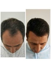 Hair Transplant - HCT Renova Clinic