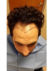 Hair Loss Treatment - HCT Renova Clinic