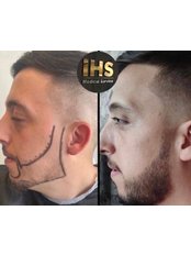 Beard Transplant - IHS Medical