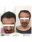 Adem and Havva Health Group LLC - Hair Transplant Before - After 