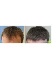 Hair Loss Specialist Consultation - Adem and Havva Health Group LLC