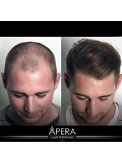 Hair Loss Specialist Consultation - APERA Hair