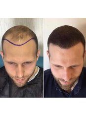 Hair Transplant - Vantage Hair Restoration