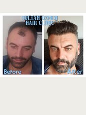 Sultan Özmen Hair Clinic - before&after