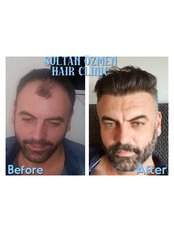 Sultan Özmen Hair Clinic - before&after 