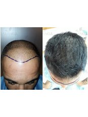 DHI - Direct Hair Implantation - Dr Baran Kul - Hair Transplant
