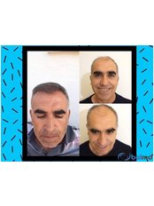Sapphire FUE Hair Transplant - BulMD (Bul Medical Consulting and Tourism Company)