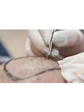 FUE - Follicular Unit Extraction - BulMD (Bul Medical Consulting and Tourism Company)