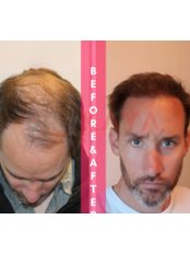Hair Transplant - Dr Kaya Hair Treatments Clinic