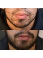 Beard Transplant - HairTeamTurkey