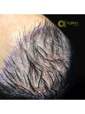 Hair Loss Specialist Consultation - Alpha Hair Central
