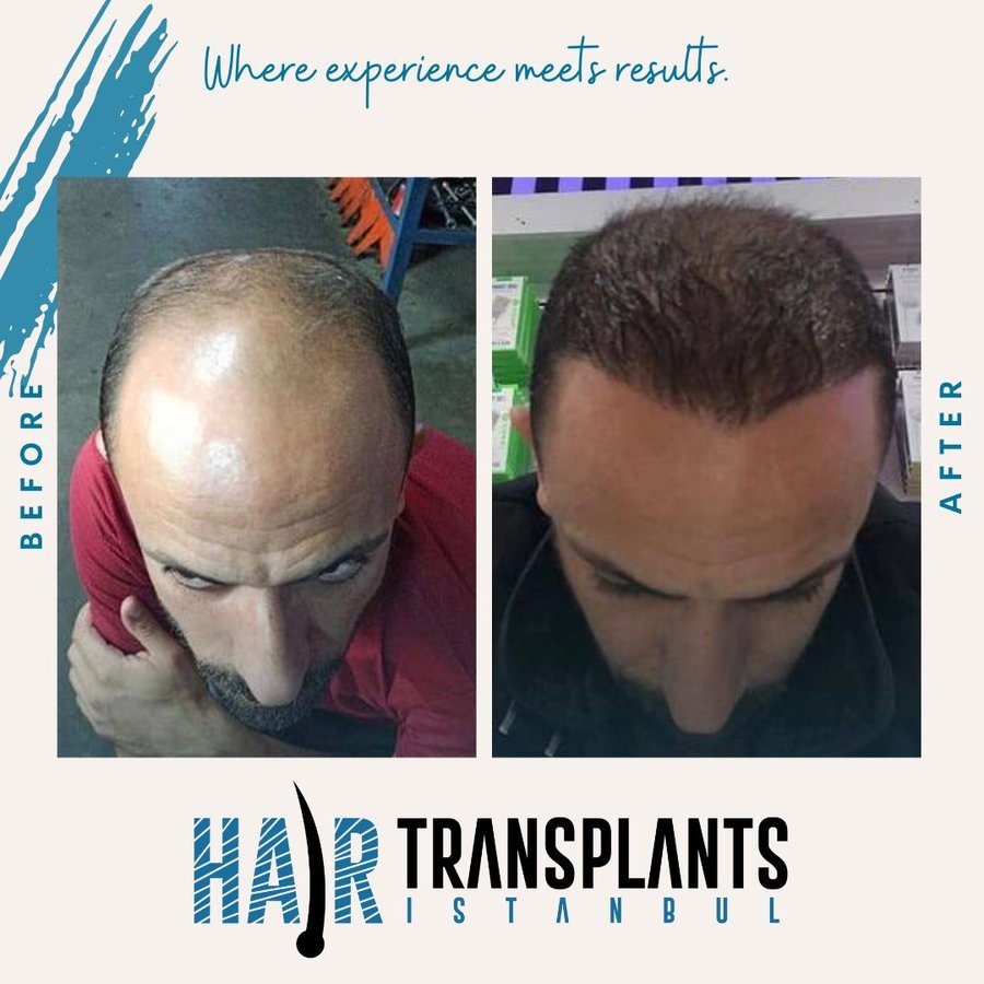 Hair Transplants Istanbul in Besiktas • Read 5 Reviews
