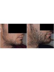 Beard Transplant Package - Holiday Estetic