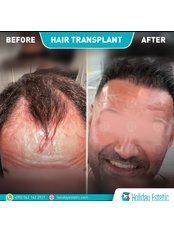 DHI - Direct Hair Implantation Package - Holiday Estetic