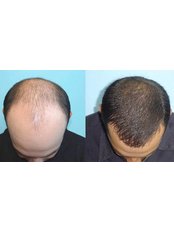 Sapphire FUE Hair Transplant Package - Holiday Estetic