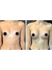 Breast Implants - Medical Excursions