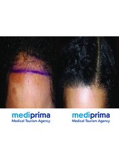 DHI - Direct Hair Implantation - Mediprima