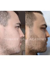 Beard Transplant - Turkey Hair Academy