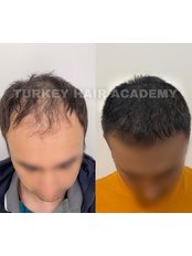 Sapphire Hair Transplant - Turkey Hair Academy