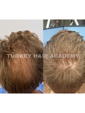 DHI - Direct Hair Implantation - Turkey Hair Academy