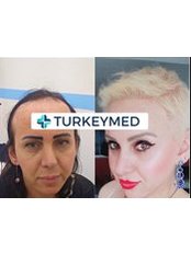 Treatment for Female Pattern Hair Loss - Turkeymed