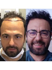 FUE - Follicular Unit Extraction - Worbimed