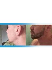 Beard Transplant - Clinic Center - Hair Transplant Clinic Turkey