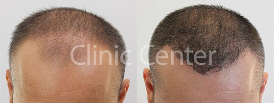 Clinic Center - Hair Transplant Clinic Turkey in Istanbul • Read 197 Reviews