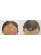 Hair Loss Treatment by ISHRS Doctor - Clinic Center - Hair Transplant Clinic Turkey