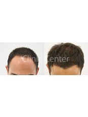 FUE - Follicular Unit Extraction by ISHRS Doctor - Clinic Center - Hair Transplant Clinic Turkey