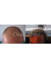 DHI - Direct Hair Implantation - Clinic Center - Hair Transplant Clinic Turkey