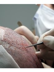 Sapphire Hair Transplant with Global Experience and ISHRS Doctor - Doctor Bircan