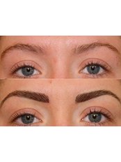 Eyebrow Transplant - Doctor Zen Clinic