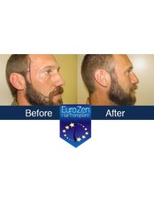 Beard Transplant - Doctor Zen Clinic