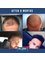 Dr Cinik Hair Transplant Clinic - FUE hair transplant 3500 grafts 