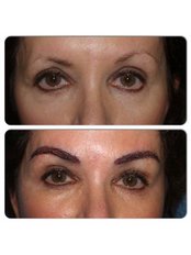 Augenbrauentransplantation - Hairestetik Turkey