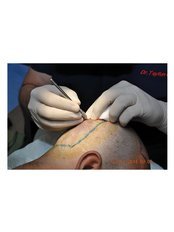 FUE Haartransplantation - Hairestetik Turkey