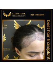 Behandlung von Haarausfall bei Frauen - Hairestetik Turkey