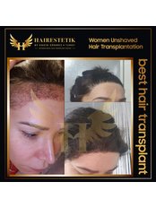 Behandlung von Haarausfall bei Frauen - Hairestetik Turkey