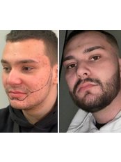 Beard Transplant - Arven clinic