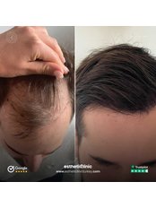Hair Transplant - Clinic Esthetic Turkey