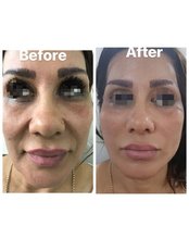 Non-Surgical Facelift - GOOD LOOK CLINIC