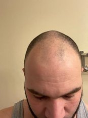 FUE - Follicular Unit Extraction - GOOD LOOK CLINIC