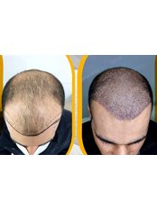 Sapphire Hair Transplant - PeraClinic Hair Transplant and Aesthetic