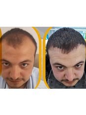 FUE - Follicular Unit Extraction - PeraClinic Hair Transplant and Aesthetic