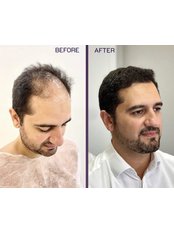 Hair Loss Specialist Consultation - Clinish Hair Transplant