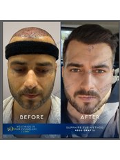 FUE - Follicular Unit Extraction - WestModern Clinic